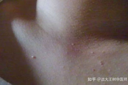脖子上长小肉粒是什么原因,探究常见健康问题背后的真相